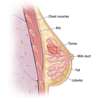 Breast Cancer Risk Assessment Meerut