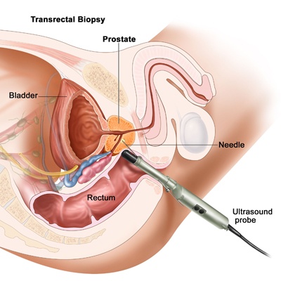 TRUS guided Prostatic Biopsy Meerut